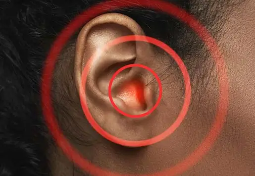Chronic Otitis Media