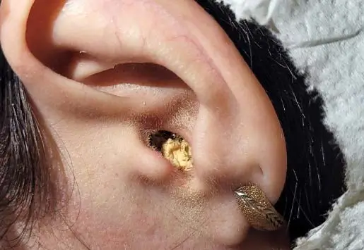 Ear Infection With Eardrum Perforation